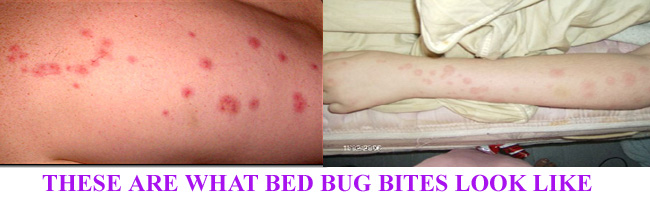 bedbug-bites-on-arm-ma-bedbug-control